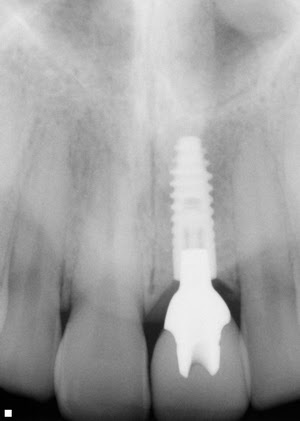 An implant